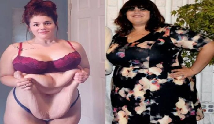 160 KG की महिला ने घटाया वजन तो बढ़ गई मुसीबत, कपड़े जैसा लटकने लगा मांस का लोथड़ा, देखें Photos ㆁ