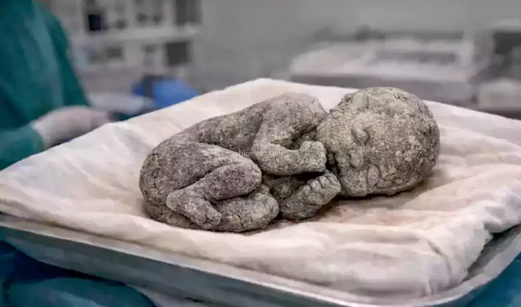 15 सालों से मां की कोख में पल रहा था बच्चा, ऑपरेशन के बाद निकला पत्थर का बच्चा