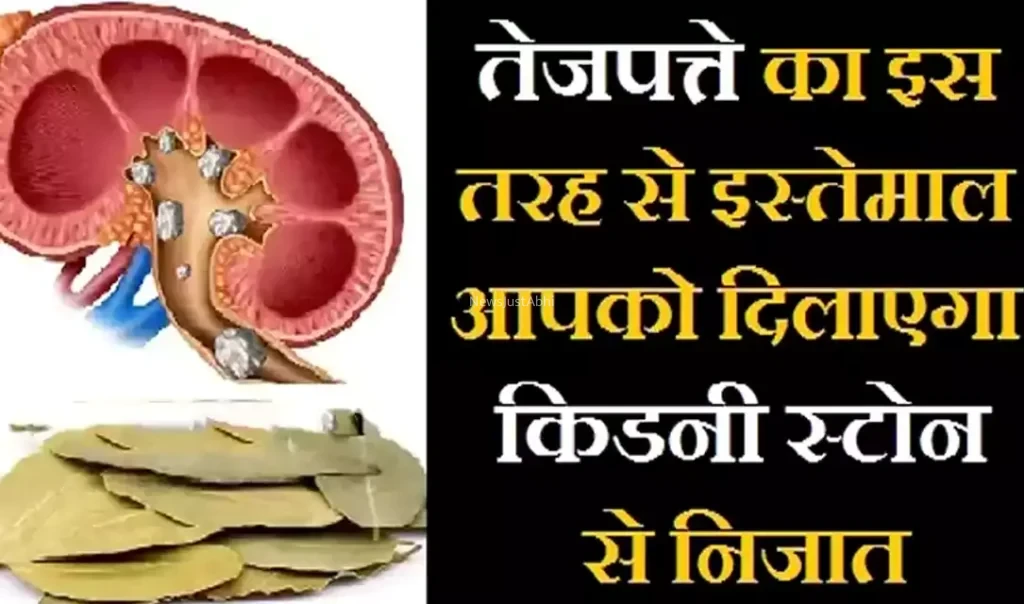 तेजपत्ते का इस तरह से करेंगे इस्तेमाल तो आपको मिलेगा किडनी स्टोन से निजात, एक बार जरूर पढ़ें ये लेख