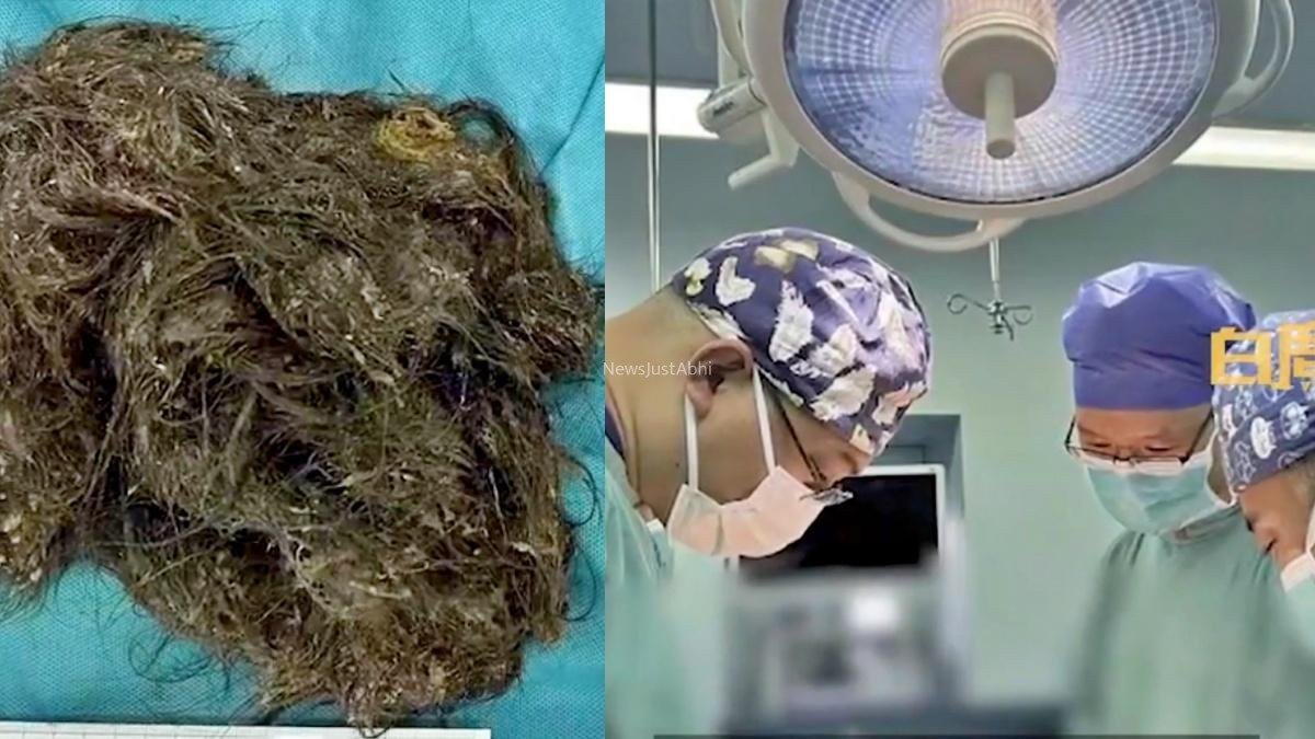 15 साल की लड़की के पेट से निकला 2Kg का बालों का गुच्छा, 6 साल से खा रही थी अपने हेयर