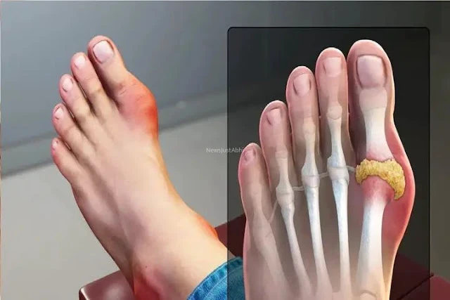 यूरिक एसिड हो जाएगा जड़ से साफ, रोज खाएं ये 5 रुपये वाला फल