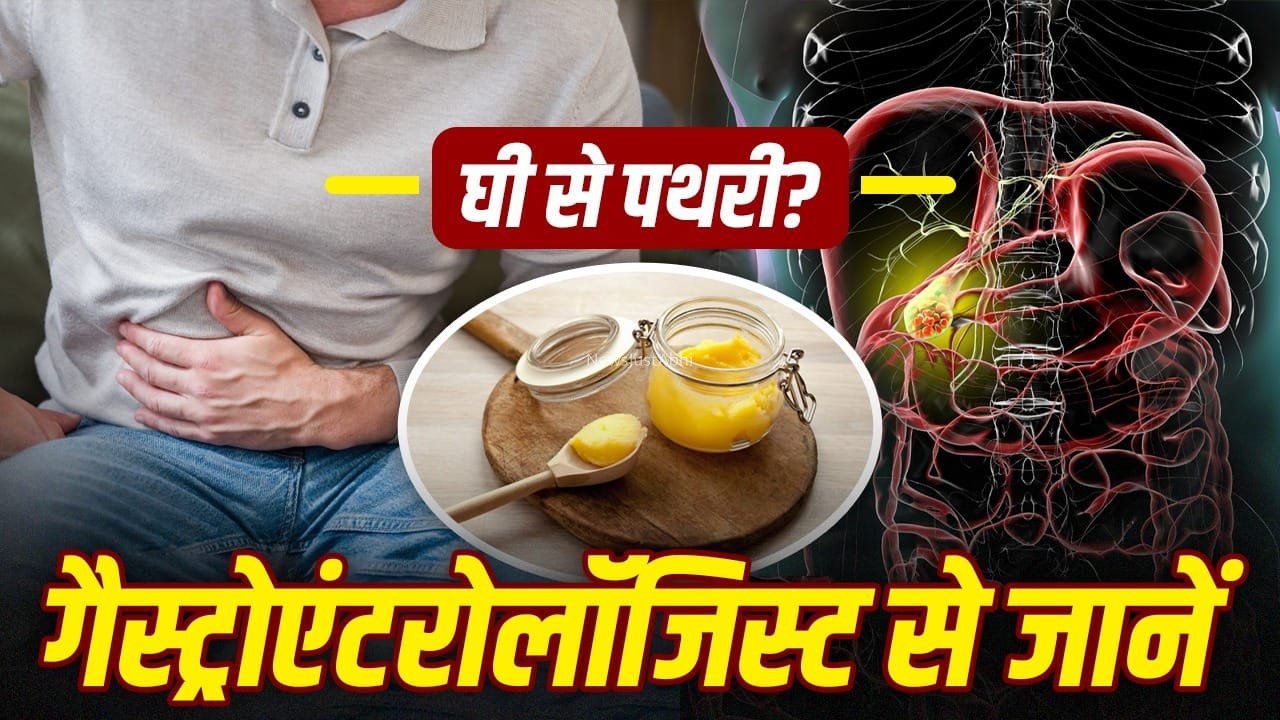 क्या ज्यादा देसी घी खाने से हो जाती है गॉल ब्लैडर में पथरी, गेस्ट्रोएंट्रोलॉजिस्ट से जानें​